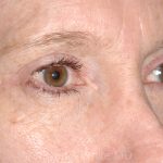 Eyelid Surgery - Blepharoplasty - Upper Eyelids Before & After Patient #5331