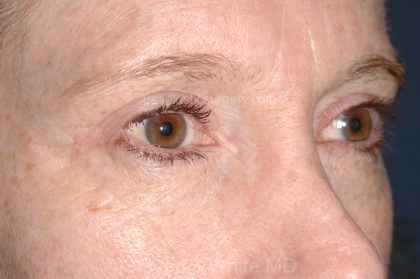 Eyelid Surgery - Blepharoplasty - Upper Eyelids Before & After Patient #5331