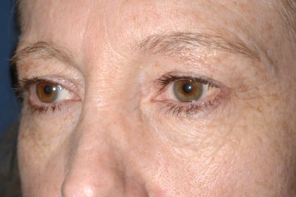 Eyelid Surgery - Blepharoplasty - Upper Eyelids Before & After Patient #5331