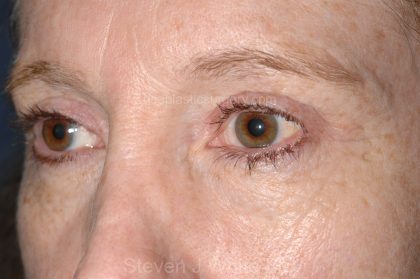 Eyelid Surgery - Blepharoplasty - Upper Eyelids Before & After Patient #5331