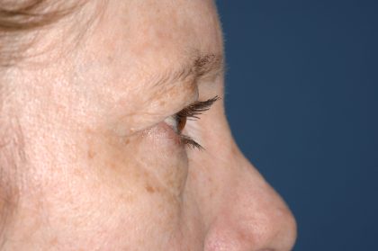 Eyelid Surgery - Blepharoplasty - Upper Eyelids Before & After Patient #5331