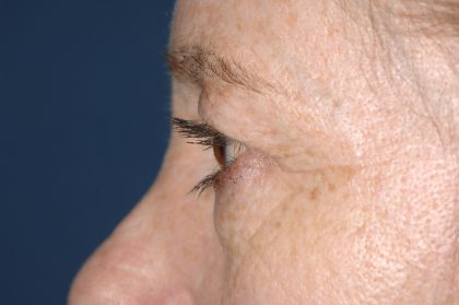 Eyelid Surgery - Blepharoplasty - Upper Eyelids Before & After Patient #5331