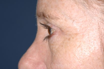 Eyelid Surgery - Blepharoplasty - Upper Eyelids Before & After Patient #5331