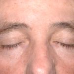 Eyelid Surgery - Blepharoplasty - Upper Eyelids Before & After Patient #5333