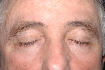 Eyelid Surgery - Blepharoplasty - Upper Eyelids Before & After Patient #5333