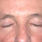 Eyelid Surgery - Blepharoplasty - Upper Eyelids Before & After Patient #5333
