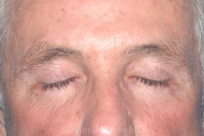 Eyelid Surgery - Blepharoplasty - Upper Eyelids Before & After Patient #5333