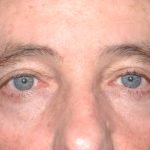 Eyelid Surgery - Blepharoplasty - Upper Eyelids Before & After Patient #5333
