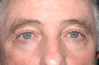 Eyelid Surgery - Blepharoplasty - Upper Eyelids Before & After Patient #5333