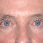 Eyelid Surgery - Blepharoplasty - Upper Eyelids Before & After Patient #5333