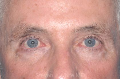 Eyelid Surgery - Blepharoplasty - Upper Eyelids Before & After Patient #5333