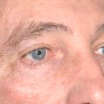 Eyelid Surgery - Blepharoplasty - Upper Eyelids Before & After Patient #5333