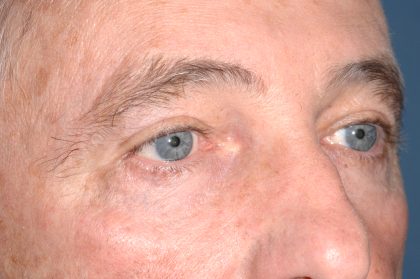 Eyelid Surgery - Blepharoplasty - Upper Eyelids Before & After Patient #5333