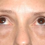 Eyelid Surgery - Blepharoplasty - Lower Eyelids Before & After Patient #5472