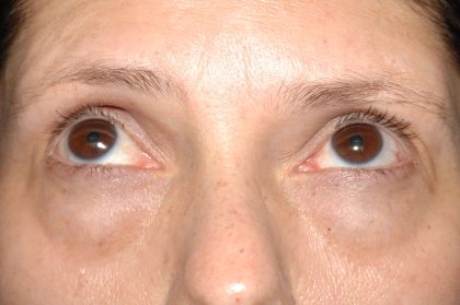 Eyelid Surgery - Blepharoplasty - Lower Eyelids Before & After Patient #5472