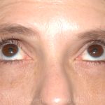 Eyelid Surgery - Blepharoplasty - Lower Eyelids Before & After Patient #5472
