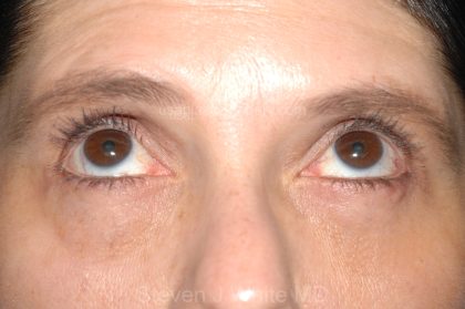 Eyelid Surgery - Blepharoplasty - Lower Eyelids Before & After Patient #5472