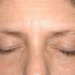 Eyelid Surgery - Blepharoplasty - Lower Eyelids Before & After Patient #5472