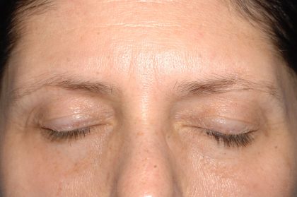 Eyelid Surgery - Blepharoplasty - Lower Eyelids Before & After Patient #5472