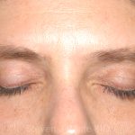 Eyelid Surgery - Blepharoplasty - Lower Eyelids Before & After Patient #5472