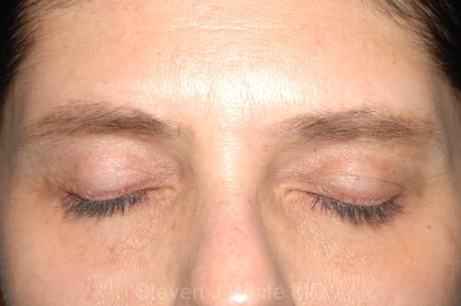 Eyelid Surgery - Blepharoplasty - Lower Eyelids Before & After Patient #5472