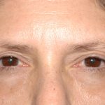 Eyelid Surgery - Blepharoplasty - Lower Eyelids Before & After Patient #5472