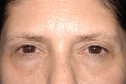 Eyelid Surgery - Blepharoplasty - Lower Eyelids Before & After Patient #5472