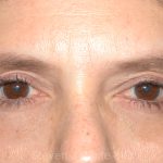 Eyelid Surgery - Blepharoplasty - Lower Eyelids Before & After Patient #5472