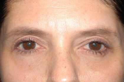 Eyelid Surgery - Blepharoplasty - Lower Eyelids Before & After Patient #5472