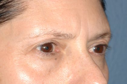 Eyelid Surgery - Blepharoplasty - Lower Eyelids Before & After Patient #5472