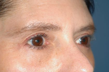 Eyelid Surgery - Blepharoplasty - Lower Eyelids Before & After Patient #5472