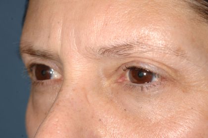 Eyelid Surgery - Blepharoplasty - Lower Eyelids Before & After Patient #5472