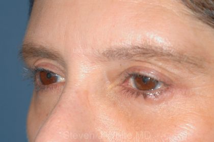 Eyelid Surgery - Blepharoplasty - Lower Eyelids Before & After Patient #5472