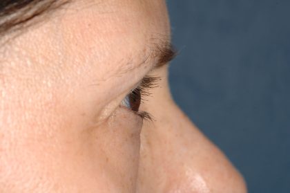 Eyelid Surgery - Blepharoplasty - Lower Eyelids Before & After Patient #5472
