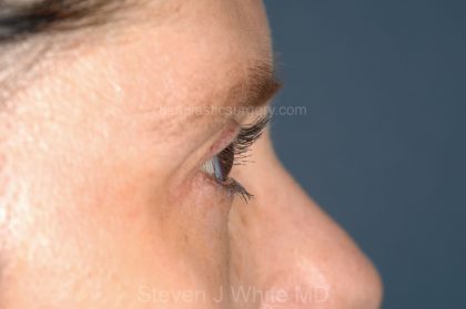 Eyelid Surgery - Blepharoplasty - Lower Eyelids Before & After Patient #5472
