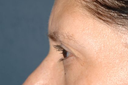 Eyelid Surgery - Blepharoplasty - Lower Eyelids Before & After Patient #5472