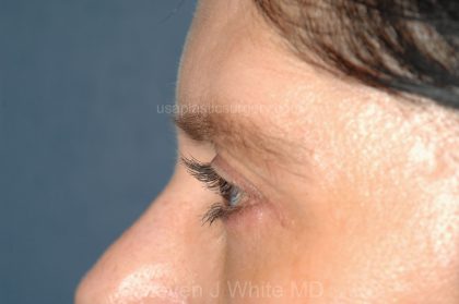 Eyelid Surgery - Blepharoplasty - Lower Eyelids Before & After Patient #5472