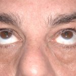 Eyelid Surgery - Blepharoplasty - Lower Eyelids Before & After Patient #5473