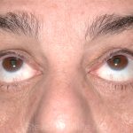 Eyelid Surgery - Blepharoplasty - Lower Eyelids Before & After Patient #5473