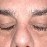 Eyelid Surgery - Blepharoplasty - Lower Eyelids Before & After Patient #5473