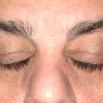 Eyelid Surgery - Blepharoplasty - Lower Eyelids Before & After Patient #5473
