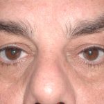 Eyelid Surgery - Blepharoplasty - Lower Eyelids Before & After Patient #5473