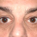 Eyelid Surgery - Blepharoplasty - Lower Eyelids Before & After Patient #5473