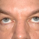Eyelid Surgery - Blepharoplasty - Lower Eyelids Before & After Patient #5475