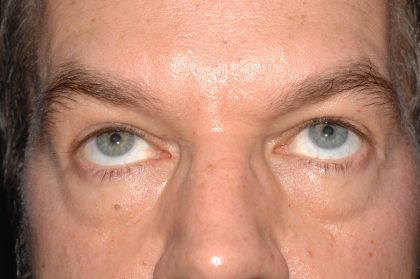 Eyelid Surgery - Blepharoplasty - Lower Eyelids Before & After Patient #5475