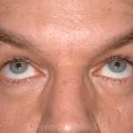 Eyelid Surgery - Blepharoplasty - Lower Eyelids Before & After Patient #5475