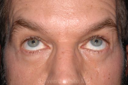 Eyelid Surgery - Blepharoplasty - Lower Eyelids Before & After Patient #5475