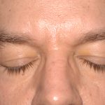 Eyelid Surgery - Blepharoplasty - Lower Eyelids Before & After Patient #5475