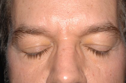 Eyelid Surgery - Blepharoplasty - Lower Eyelids Before & After Patient #5475