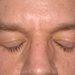 Eyelid Surgery - Blepharoplasty - Lower Eyelids Before & After Patient #5475